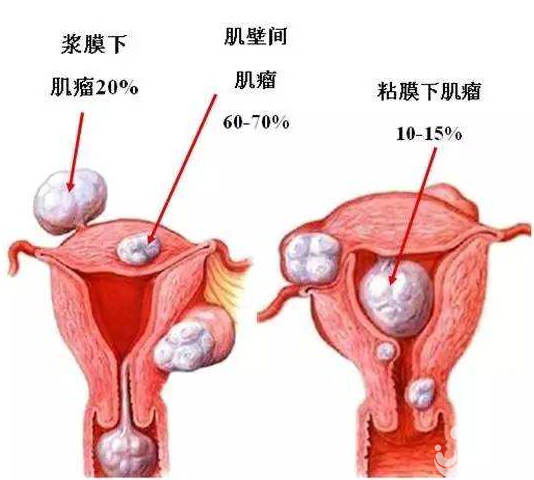 子宮肌瘤疾病會阻礙女性懷孕嗎？