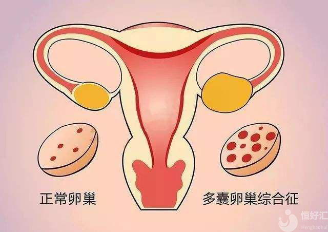 多囊卵巢綜合征，女性最痛恨的疾病之一