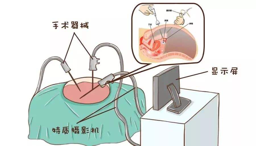 什么人適合腹腔鏡檢查呢？