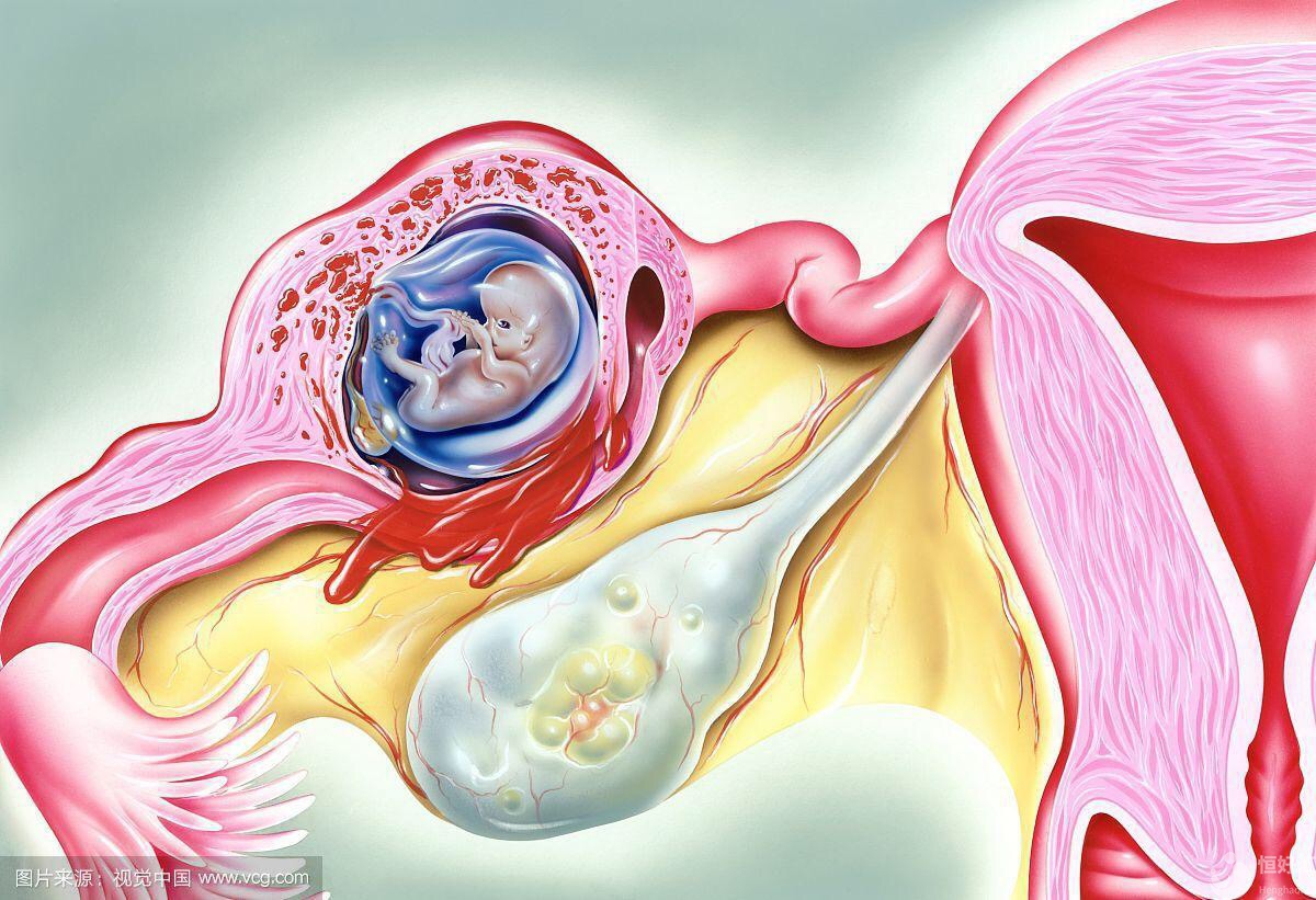 做試管嬰兒會發生宮外孕嗎？