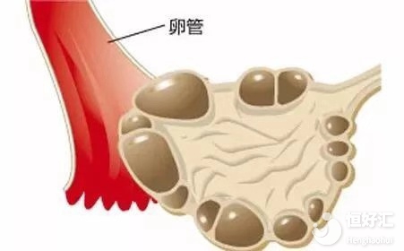 多囊卵巢適宜做試管嬰兒?jiǎn)幔? /></a>
	<div   id=