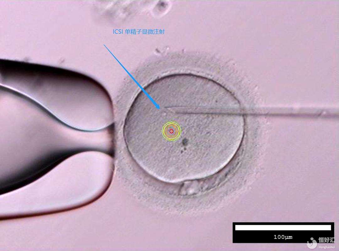 單精子卵泡漿細胞顯微注射技術(shù)是如何進行的呢？