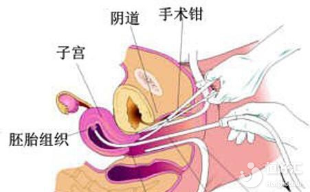 第一胎打胎的后果，看完你還敢亂來嗎？