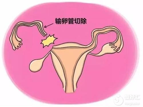 輸卵管切除還能懷孕嗎？醫生：試管嬰兒可一試