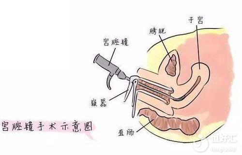 子宮內膜息肉會不會影響做試管嬰兒？