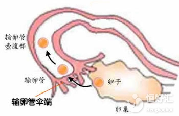 卵子排不到右側輸卵管怎么辦？或許你可以這樣做