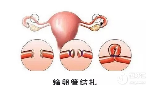 做試管嬰兒必須結扎輸卵管嗎？答案沒那么簡單