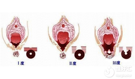 以下產婦可能需要會陰切除術，來看看有沒有你？