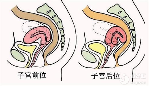 子宮后位或許會(huì)增加不孕幾率，這幾點(diǎn)問題請(qǐng)注意