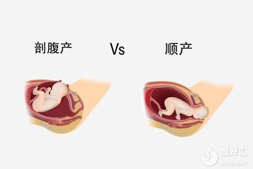 順產VS剖腹產最后誰贏了？醫生：適合的才最好