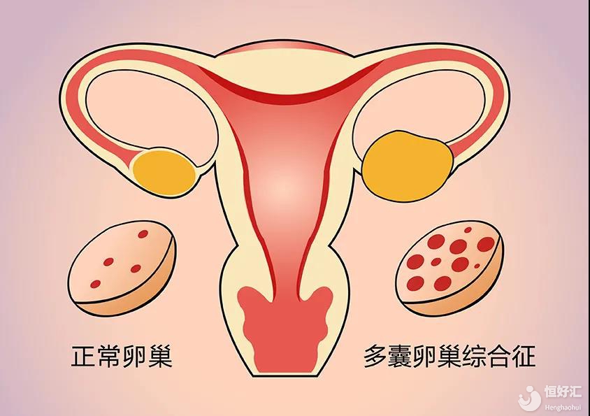 多囊卵巢綜合征嚴重嗎？治療多囊你要了解它！