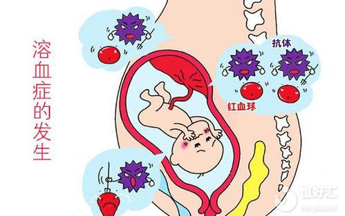 如何診斷新生兒溶血病？醫(yī)生：或許產(chǎn)前檢查就可以