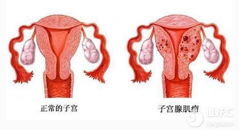 備孕期查出子宮肌瘤？這3點方法教你如何應對