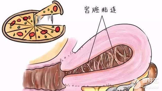 宮腔粘連影響生育？做好這幾點助你快速懷孕