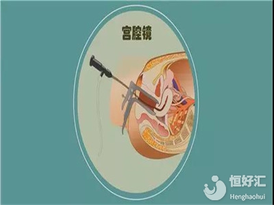 試管嬰兒需要做宮腔鏡檢查嗎？看完這個才知道