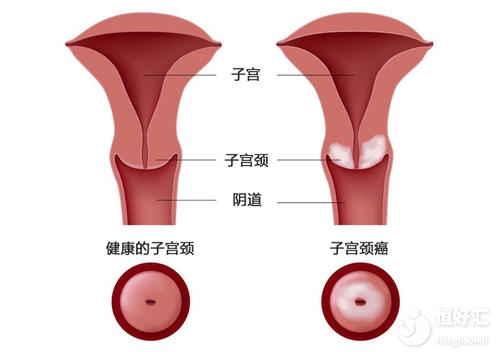 這3種子宮疾病容易引起不孕，快來(lái)看看你有嗎？