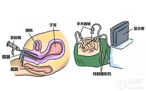 試管嬰兒為什么要做宮腔鏡檢查？醫生告訴你