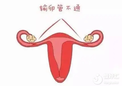 <strong>為什么十個不孕女性有七個是輸卵管原因？</strong>