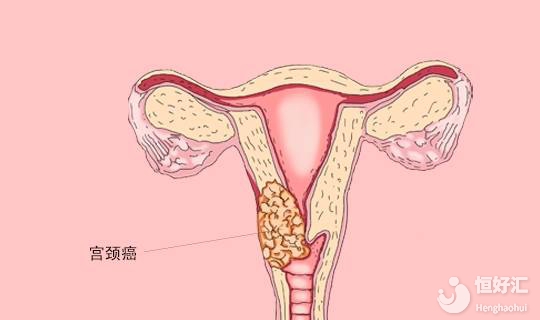 宮頸癌治療