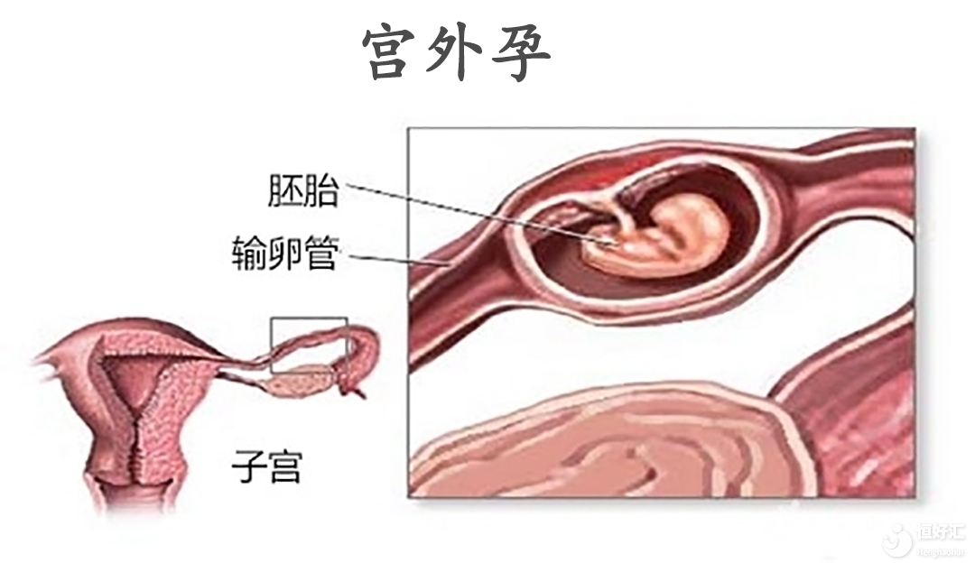 宮外孕早有征兆？千萬要注意這幾個癥狀