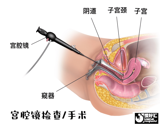 宮腔分離怎么治療