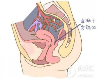 <strong>檢查發(fā)現(xiàn)有盆腔積液，需要治療嗎？</strong>