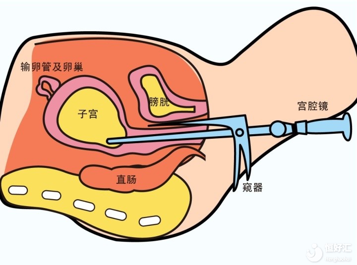 試管嬰兒移植前，為什么醫生會讓你去做宮腔鏡？