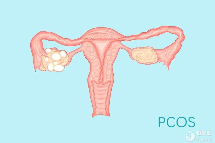 為什么多囊卵巢越來越常見？女性朋友要警惕2個病因