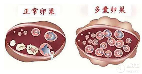 多囊卵巢不運動不治療，會導致不孕？