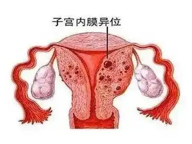 子宮內膜異位癥為什么會引發不孕？