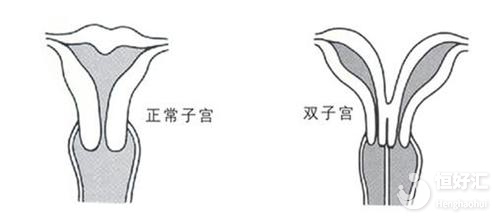 注意！子宮畸形正危及你的 “好孕”?！